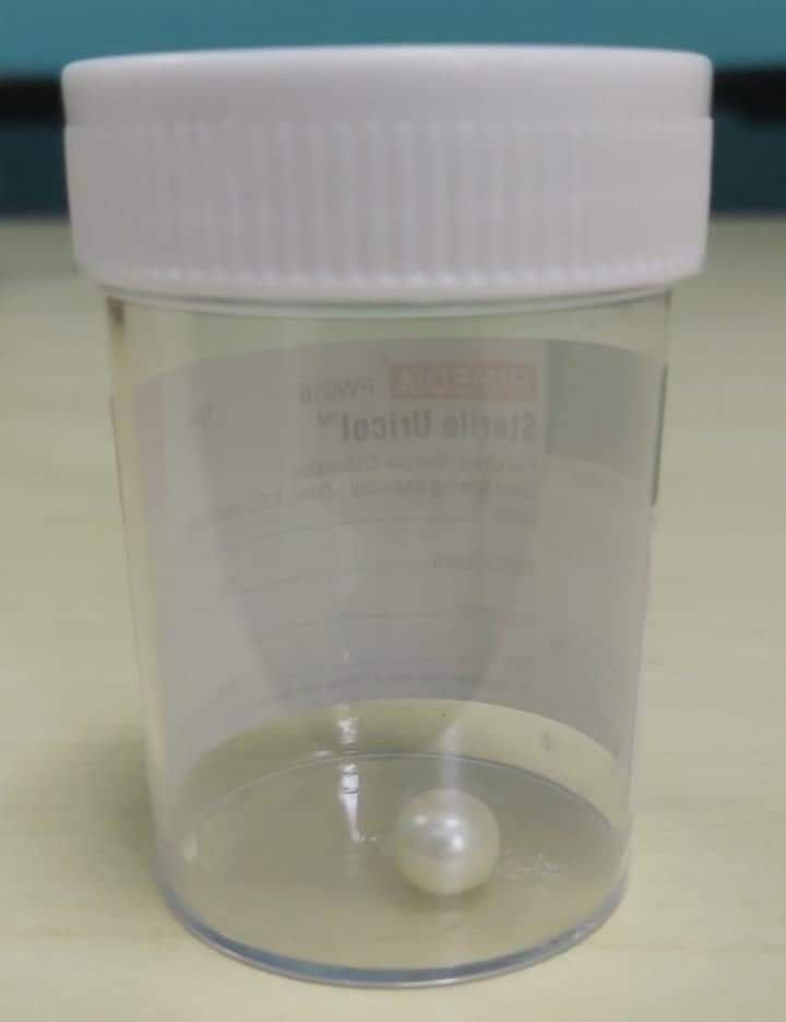 ތިން އަހަރުގެ އަންހެންކުއްޖެއްގެ ނޭވާހޮޅީގައި ތާށިވި މިނާފުކެއް ނަގައިފި