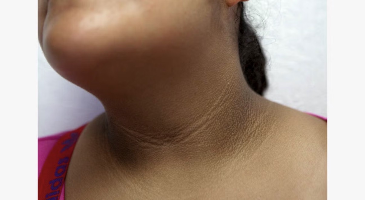 ކަރުގެ ހަންގަނޑު ކަޅުވުމަކީ އިންސިއުލިން ރެސިސްޓެންސްގެ ނުރައްކާތެރި ސިގްނަލެއް!