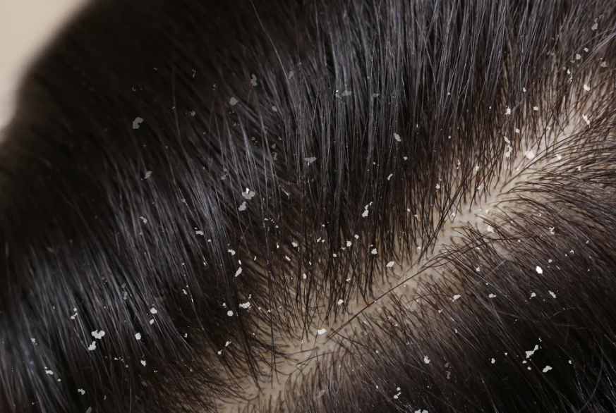 ބޮލުން ހަންފޮޅެނަމަ ބޭނުން ކުރަންވީ މި އެއްޗެހި