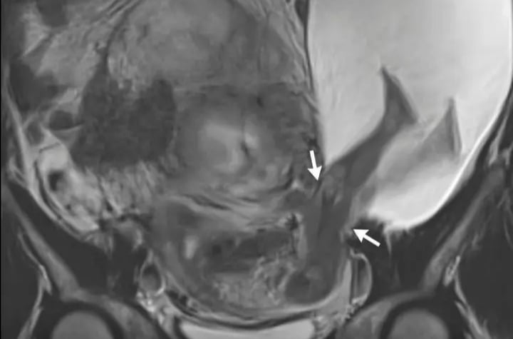 ވިހެއުމުގެ ތެރޭގައި ރަހިމު ފަޅައިގެން ގޮސް ކުއްޖާގެ ފުރާނަ އަތްމައްޗަށް