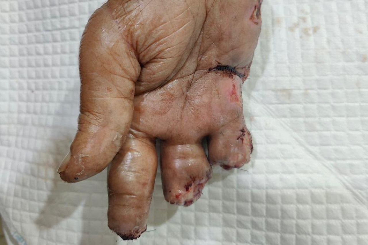 ދުވަސްވީ އަންހެނެއްގެ އަތުގެ އިނގިލިތައް ބުރިކޮށްލި މައްސަލައެއް ބަލަނީ