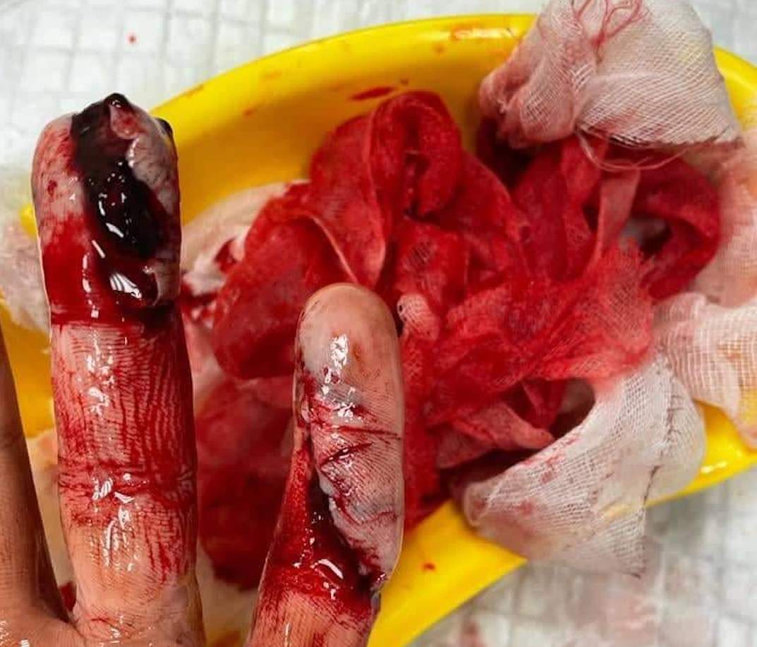 މިޔަރަށް ކާންދޭން އުޅުނު ފަތުރުވެރިއެއްގެ އަތް ކާލައިފި