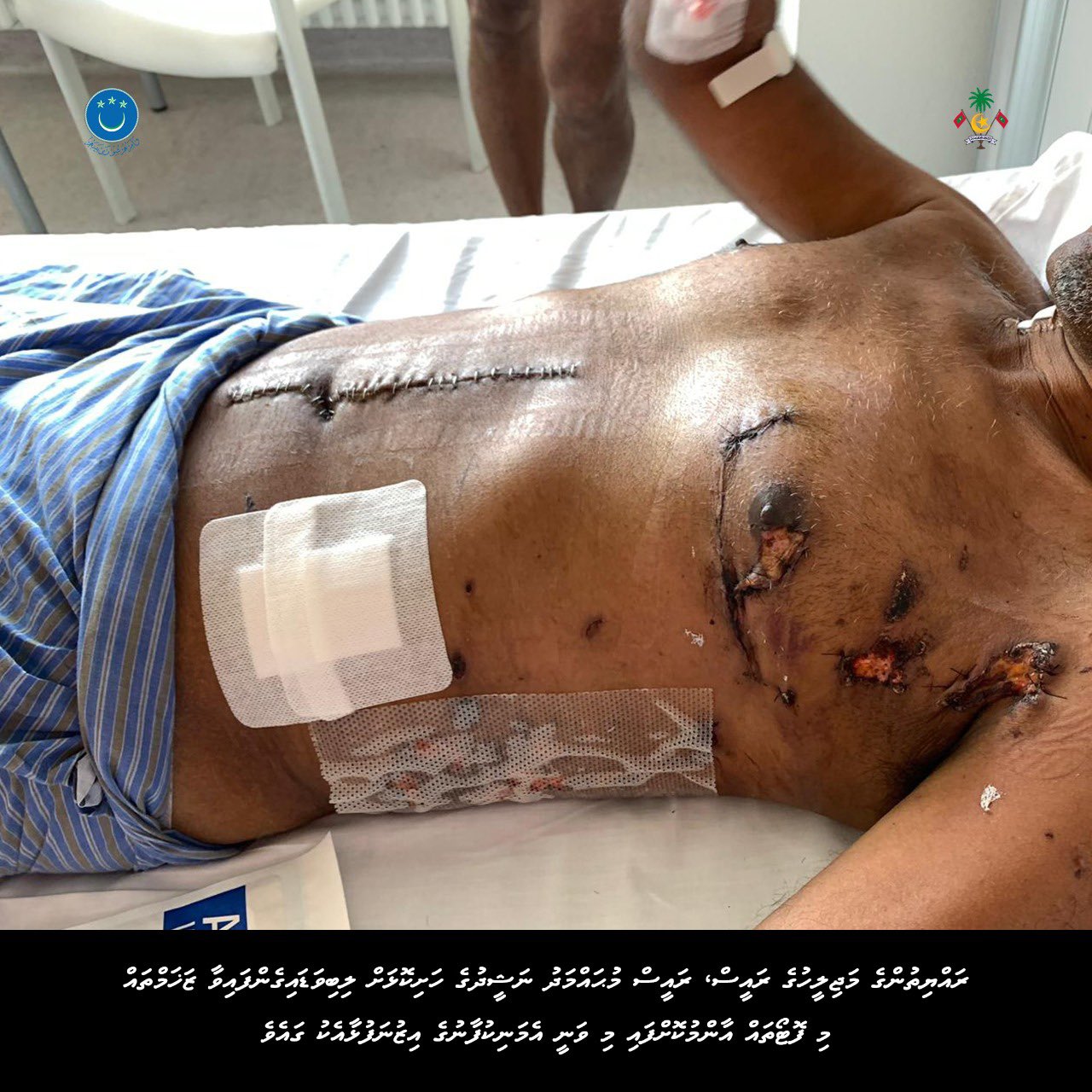 ރައީސް ނަޝީދުގެ ހަށިކޮޅަށް ލިބިފައިވާ އަނިޔާތަކުގެ ފޮޓޯތައް އާންމު ކޮށްފި