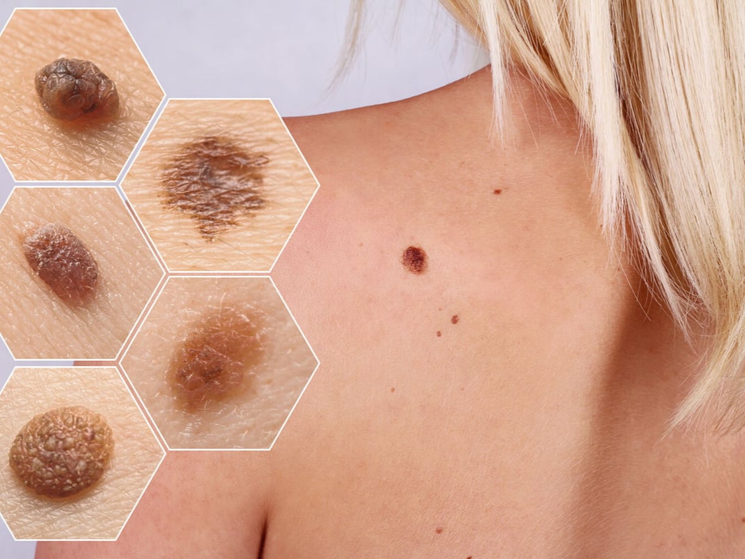 ހަމުގެ ކެންސަރު - ގިނަދުވަސްވީ އުން، ބިހިފަދަ ތަންތަނަށް ސަމާލުވޭ